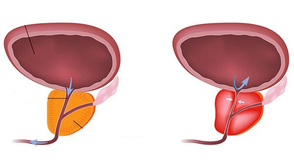 amoxicillin and enlarged prostate étrend kiegészítők prosztatagyulladásra