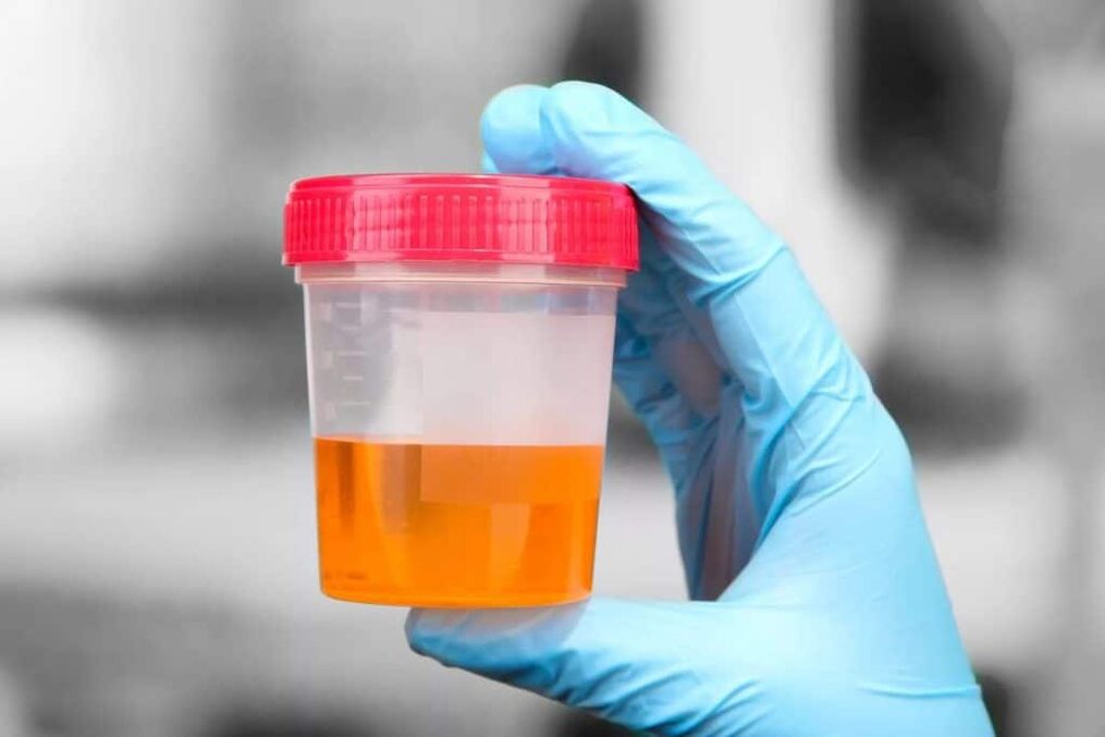 urine with blood in calculous prostatitis
